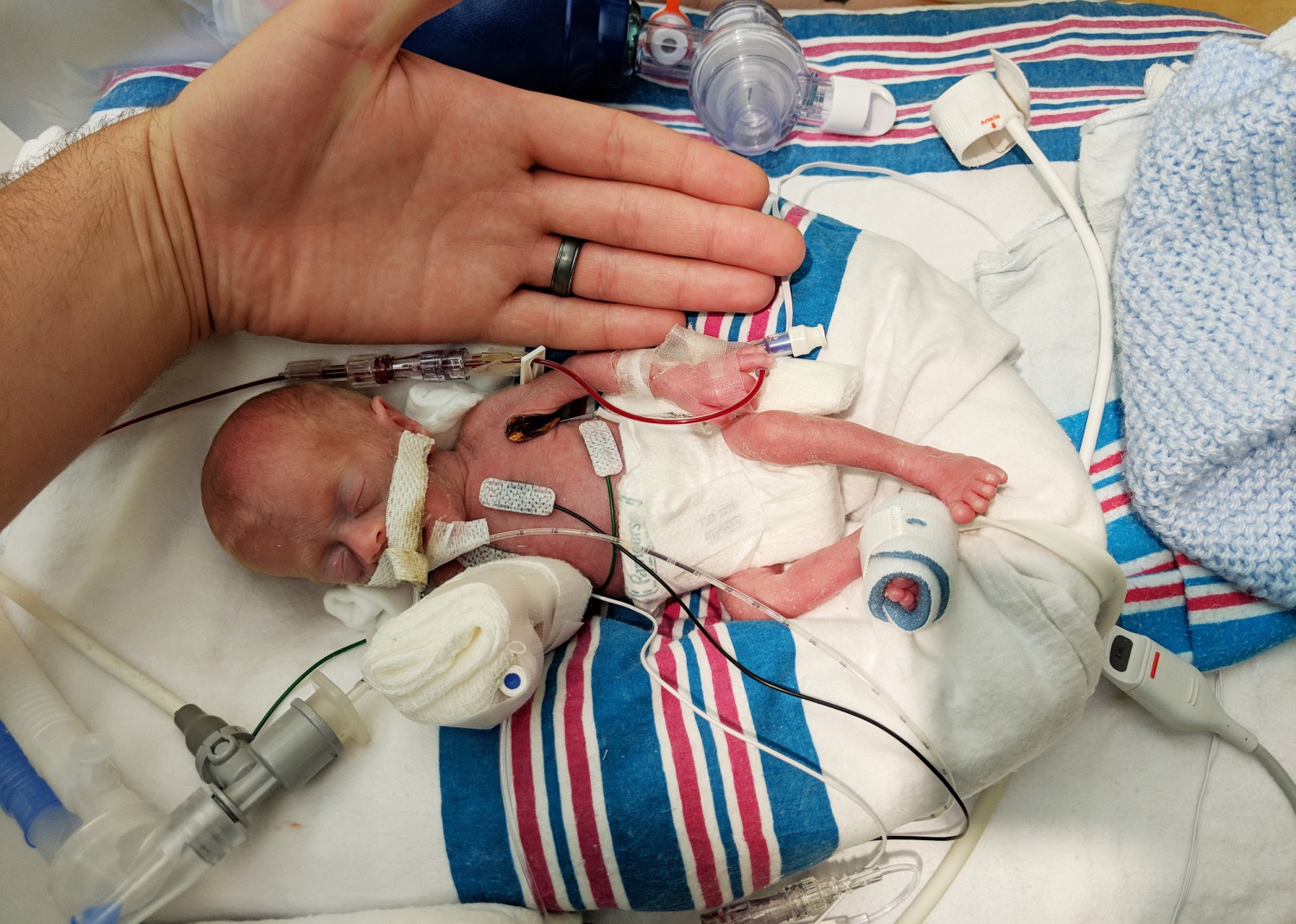 From 11 Ounces To 11 Pounds Baby Returns Home Against Odds
