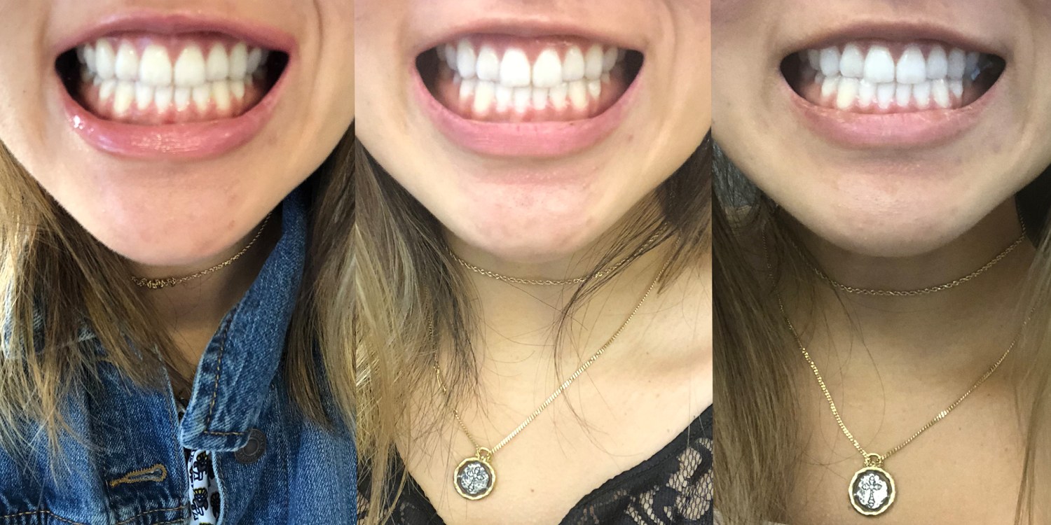 Do LED teeth whitening kits work? I tried teeth whitening at home.