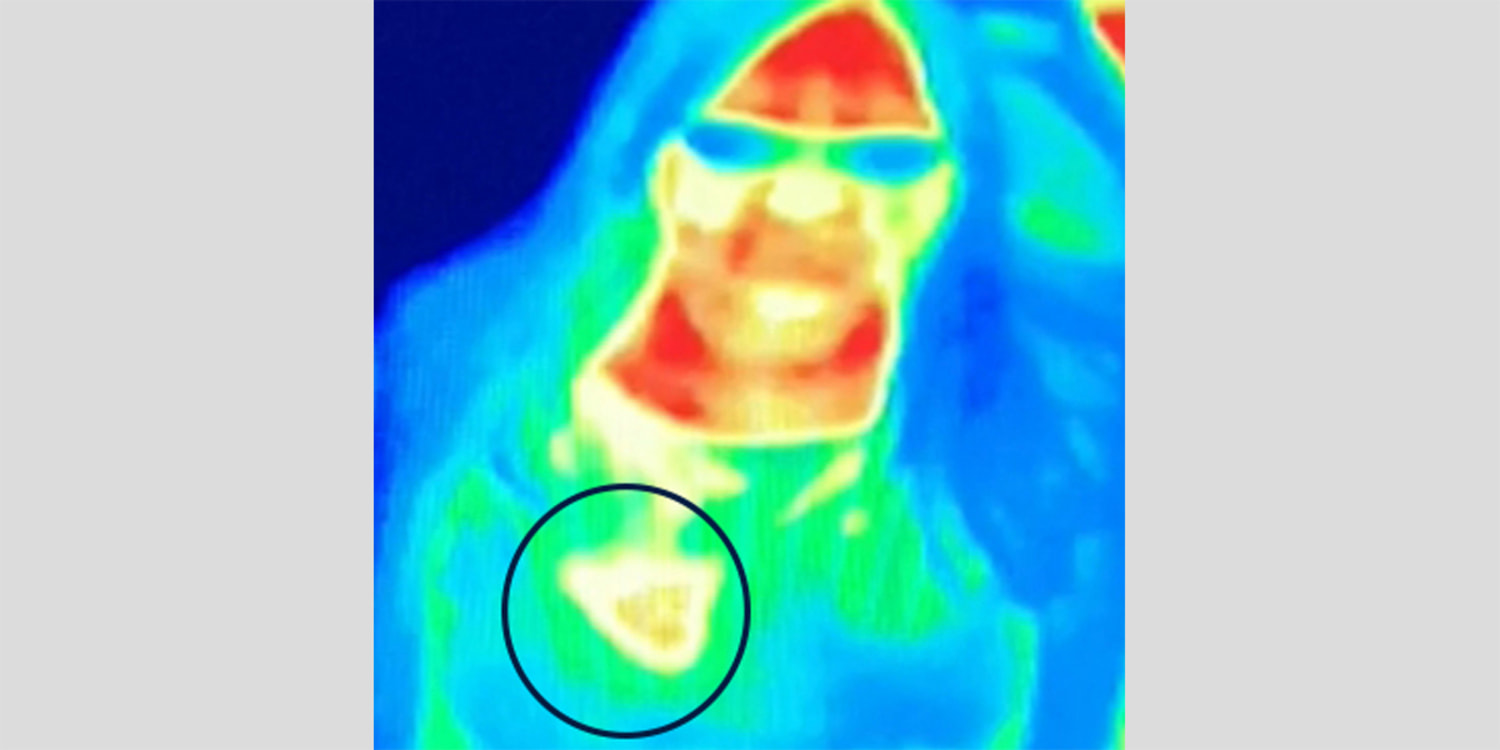 Woman says thermal camera spotted breast cancer