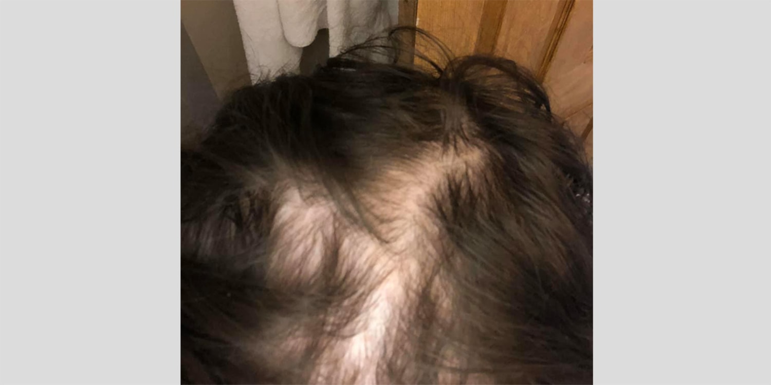 Former Devacurl Aficionados Allege Products Cause Hair Loss
