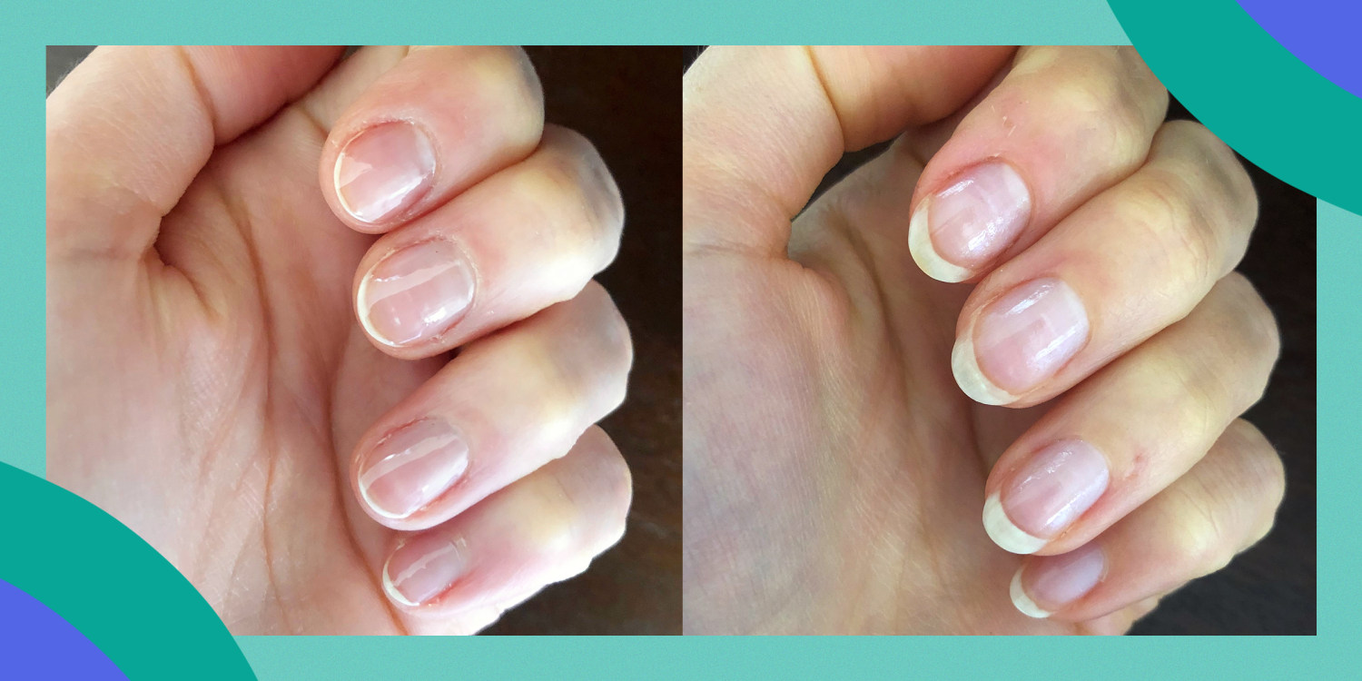 Vertical ridges on finger nail | BabyCentre