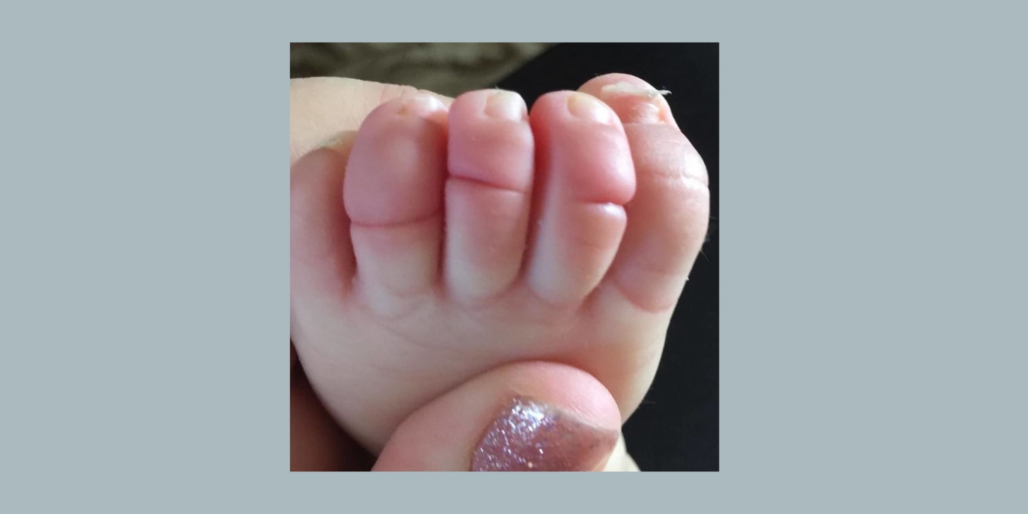 Why Does My Baby Have Spoon Shaped Nails (Koilonychia)? | Footfiles