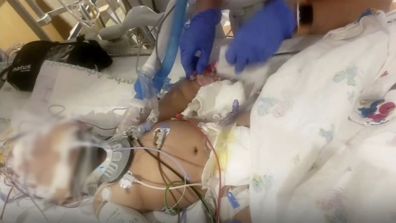 Un bebé latino de 5 meses lucha por su vida tras ser golpeado por su niñera