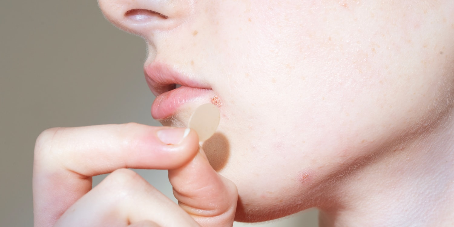I Wore These Invisible Pimple Patches for a Month and No One Noticed