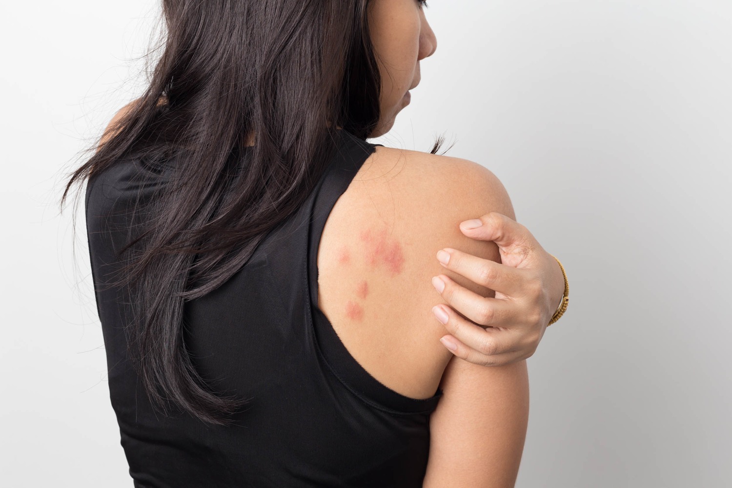 This skin rash is back after almost vanishing during the pandemic