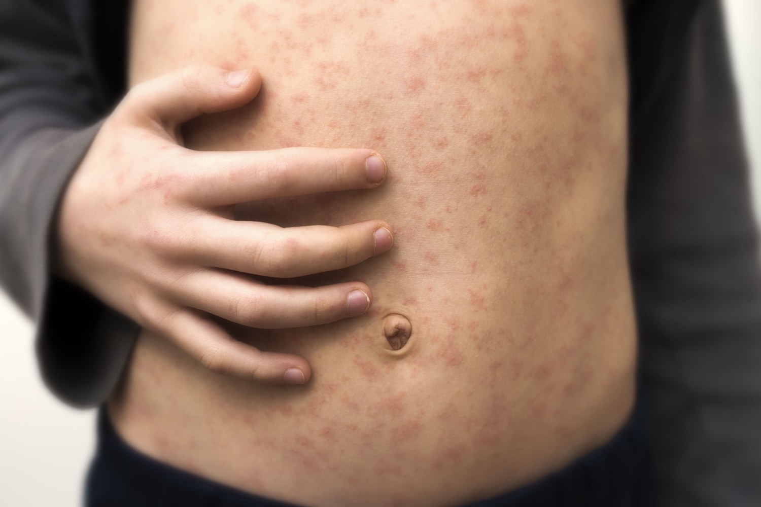 This skin rash is back after almost vanishing during the pandemic - The  Washington Post