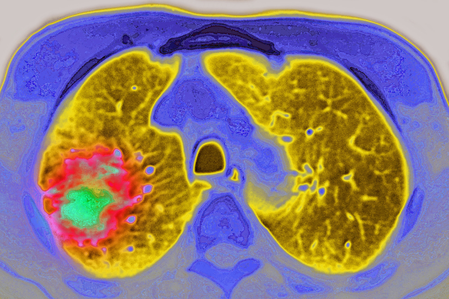 glp-1 and cancer GLP-1 drugs may reduce the risk of cancer progressing, study suggests