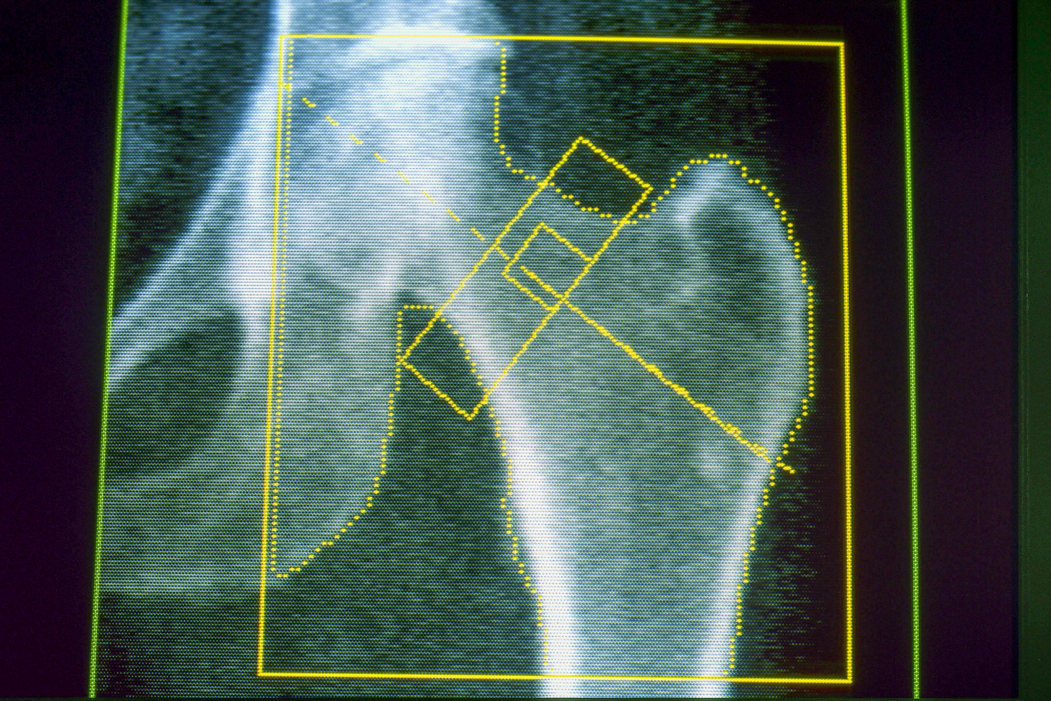 semaglutide bone density loss GLP-1s may increase risk of osteoporosis and gout, new research finds