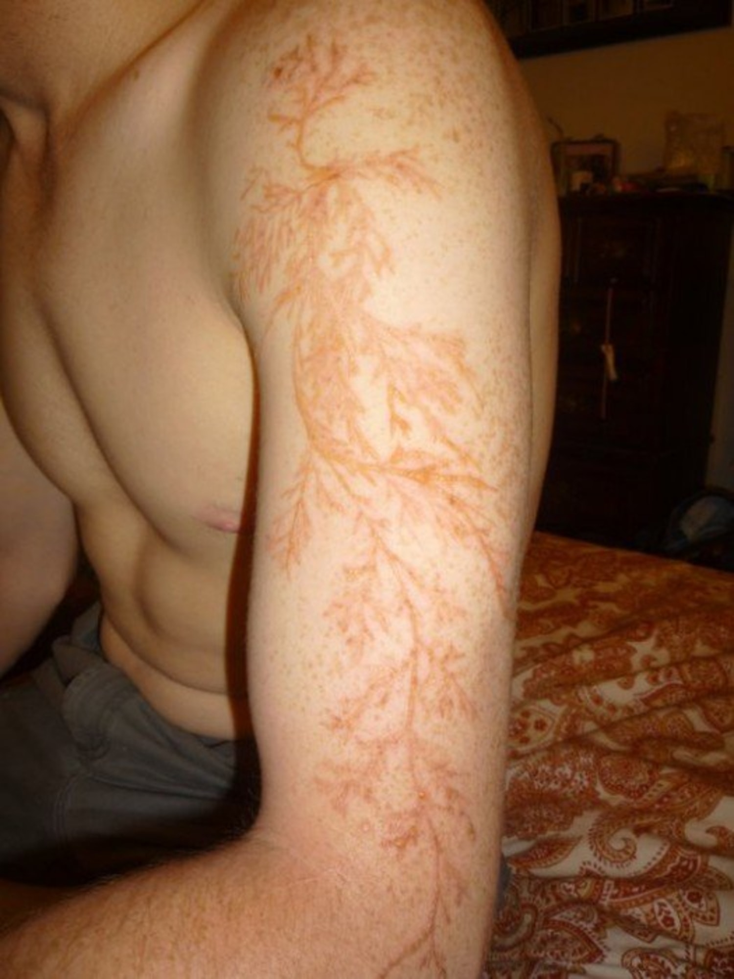 Here's what a lightning strike can do to your skin