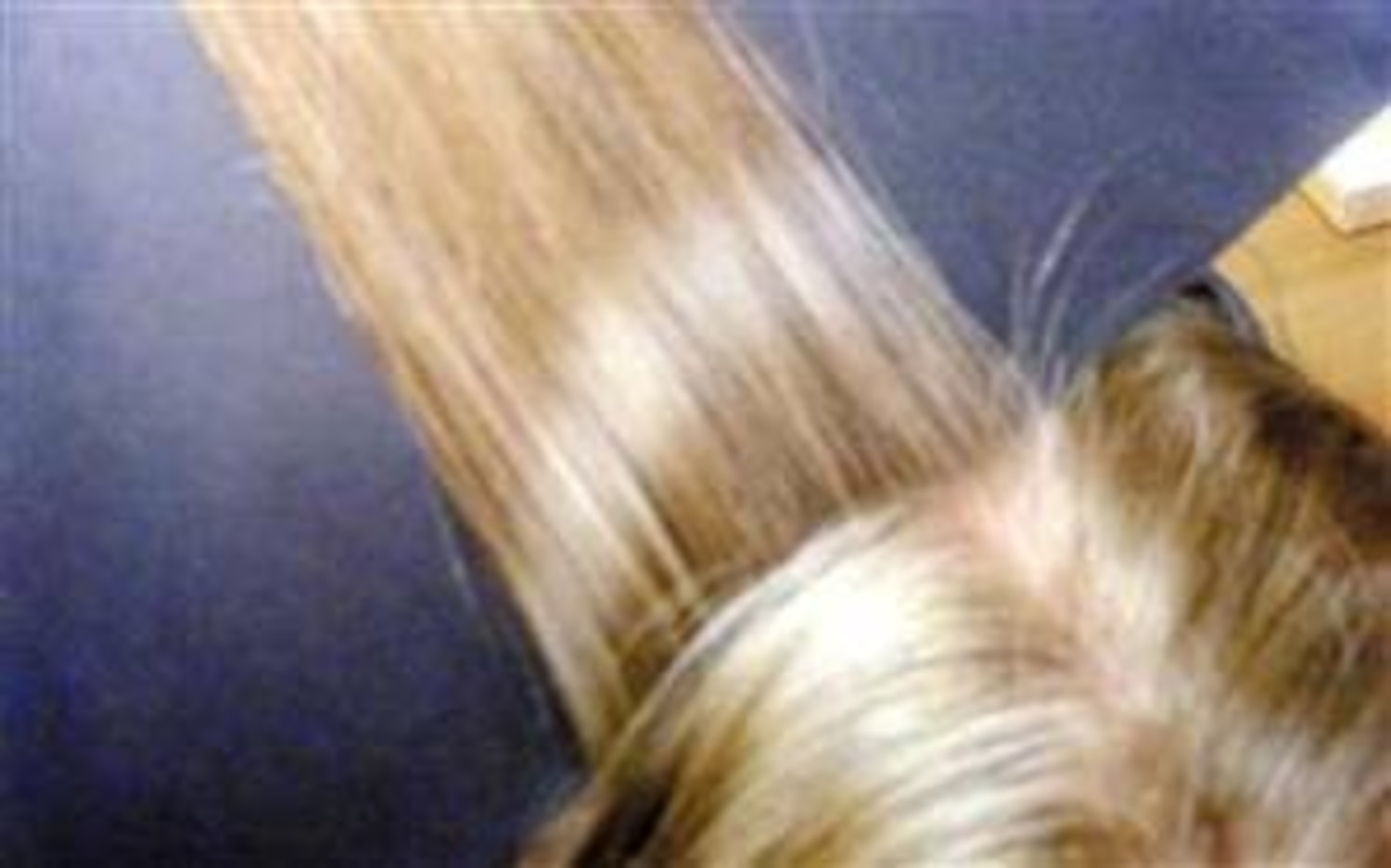 Too much malaria drug bleached teen's hair