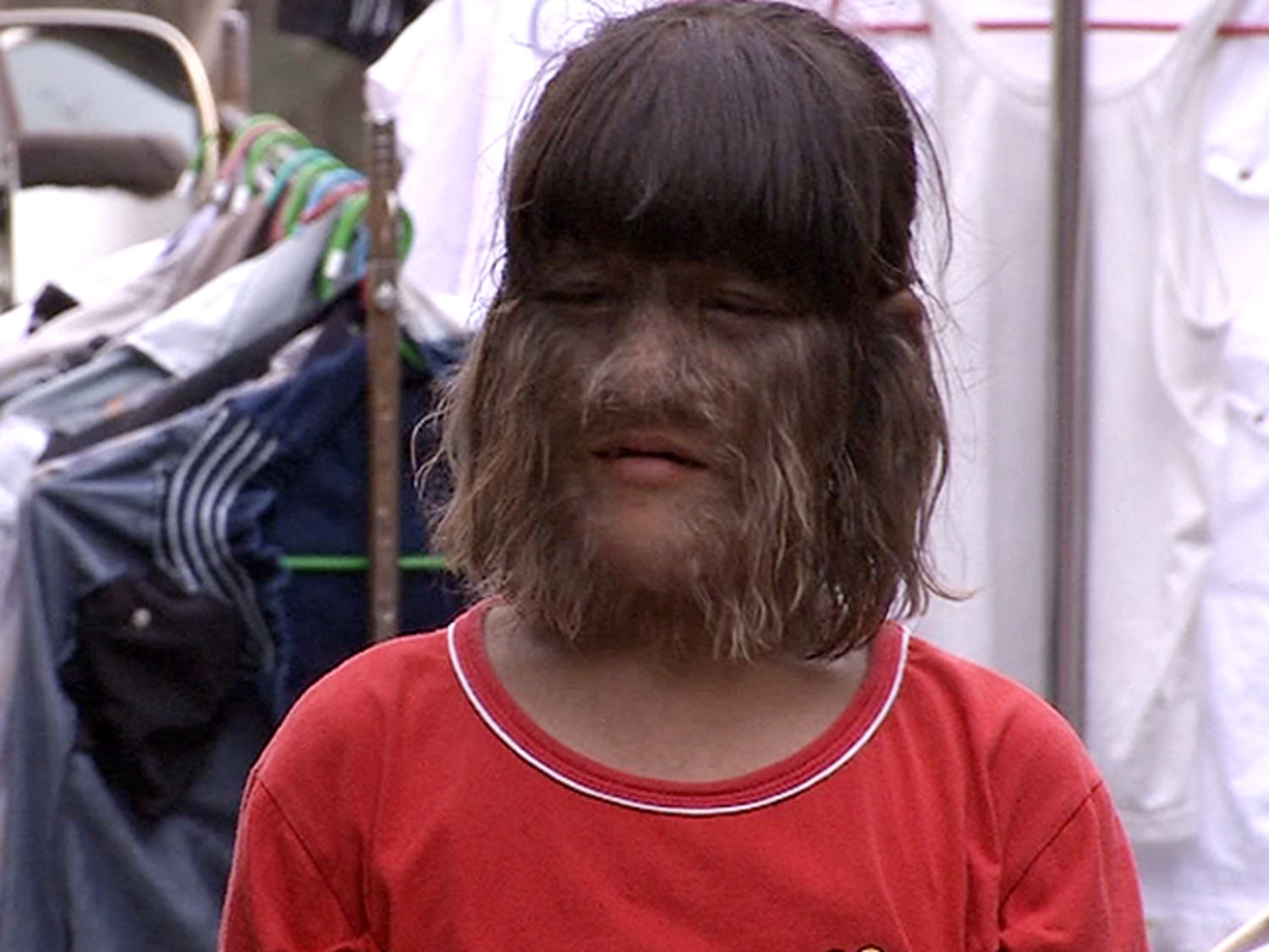 Hope for girl born with hair covering half her face