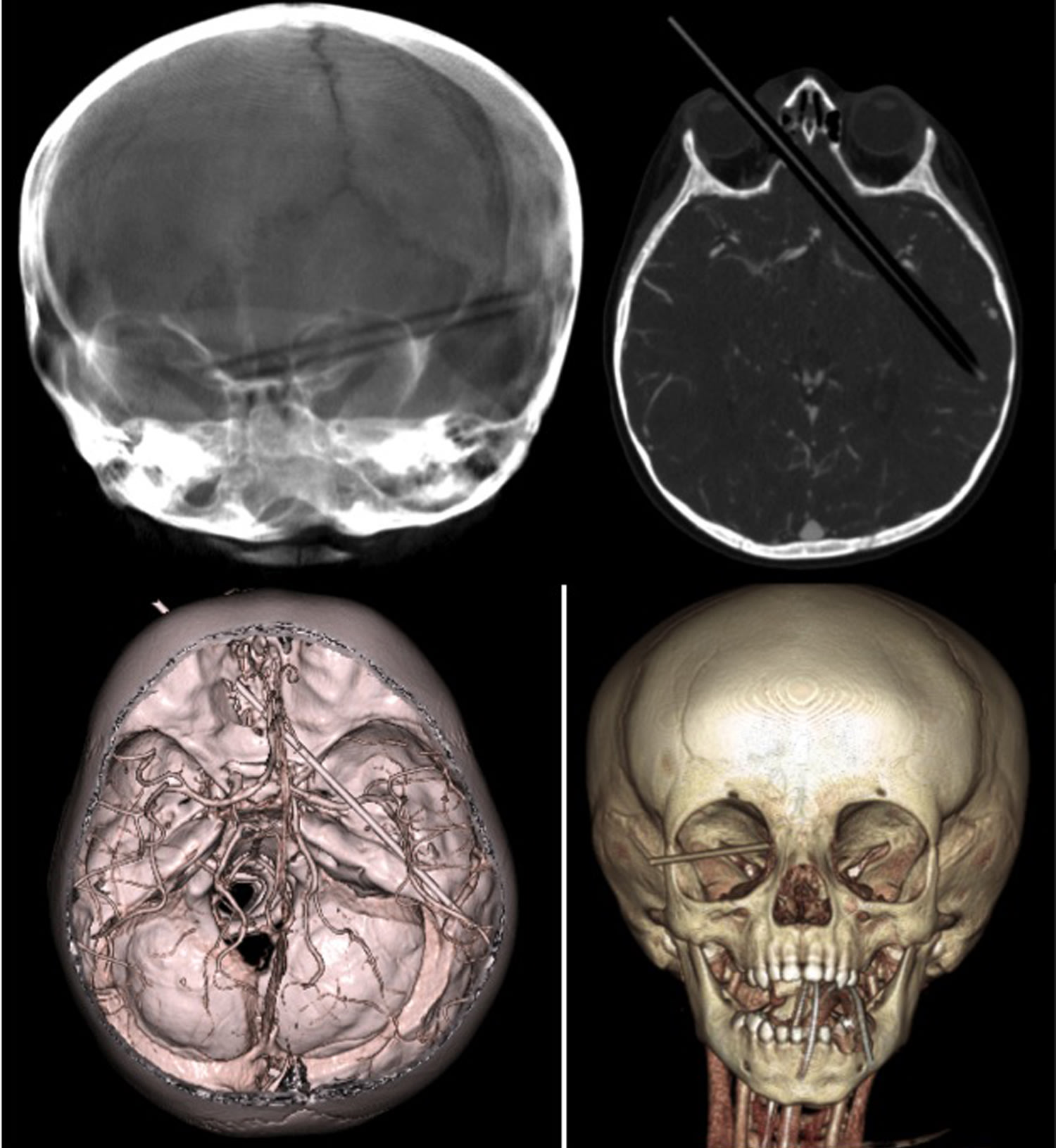 How to steal a body-scan picture