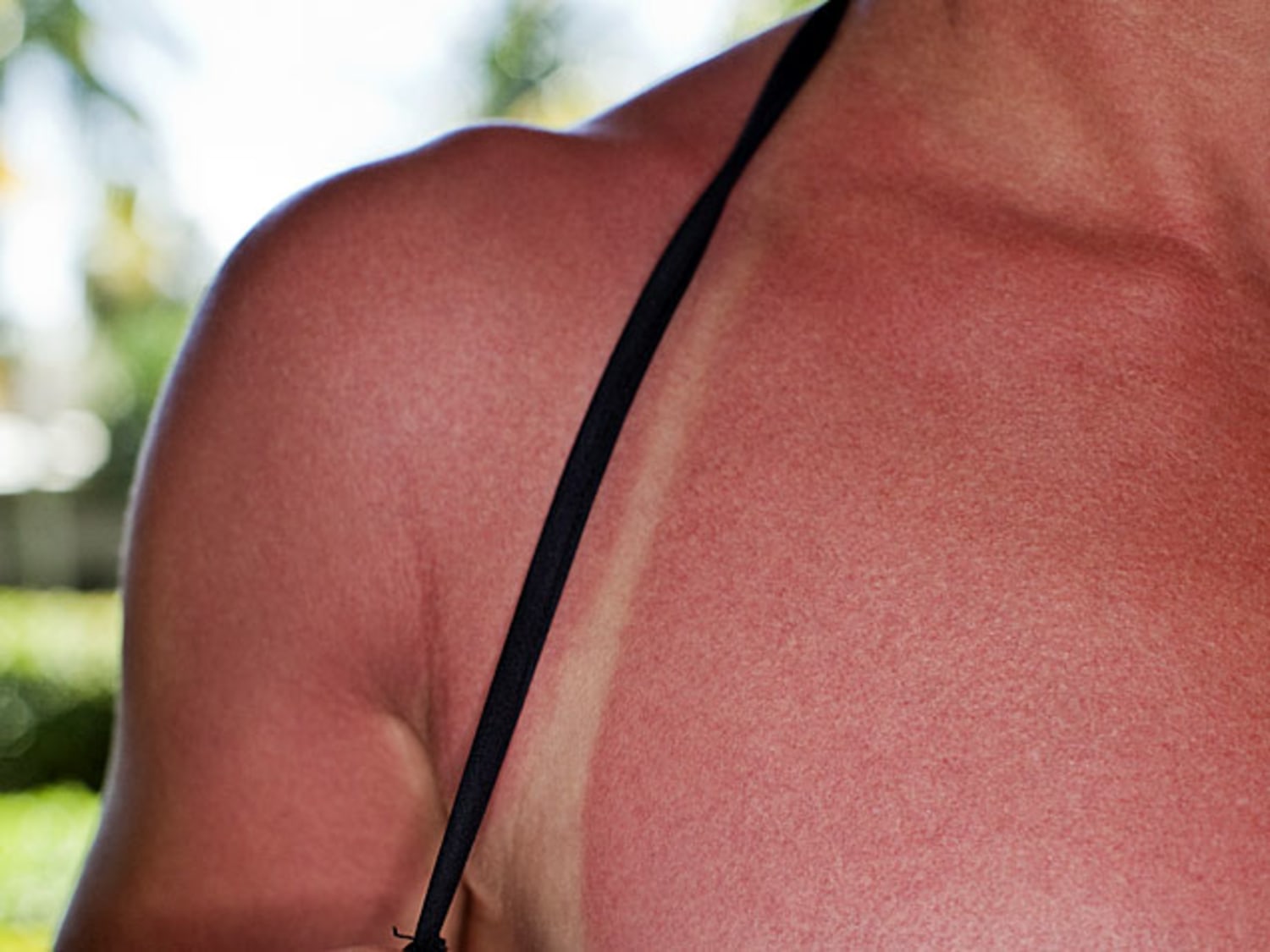 From Sunburn to Razor Burn, How to Prevent Summer Skin Care Disasters