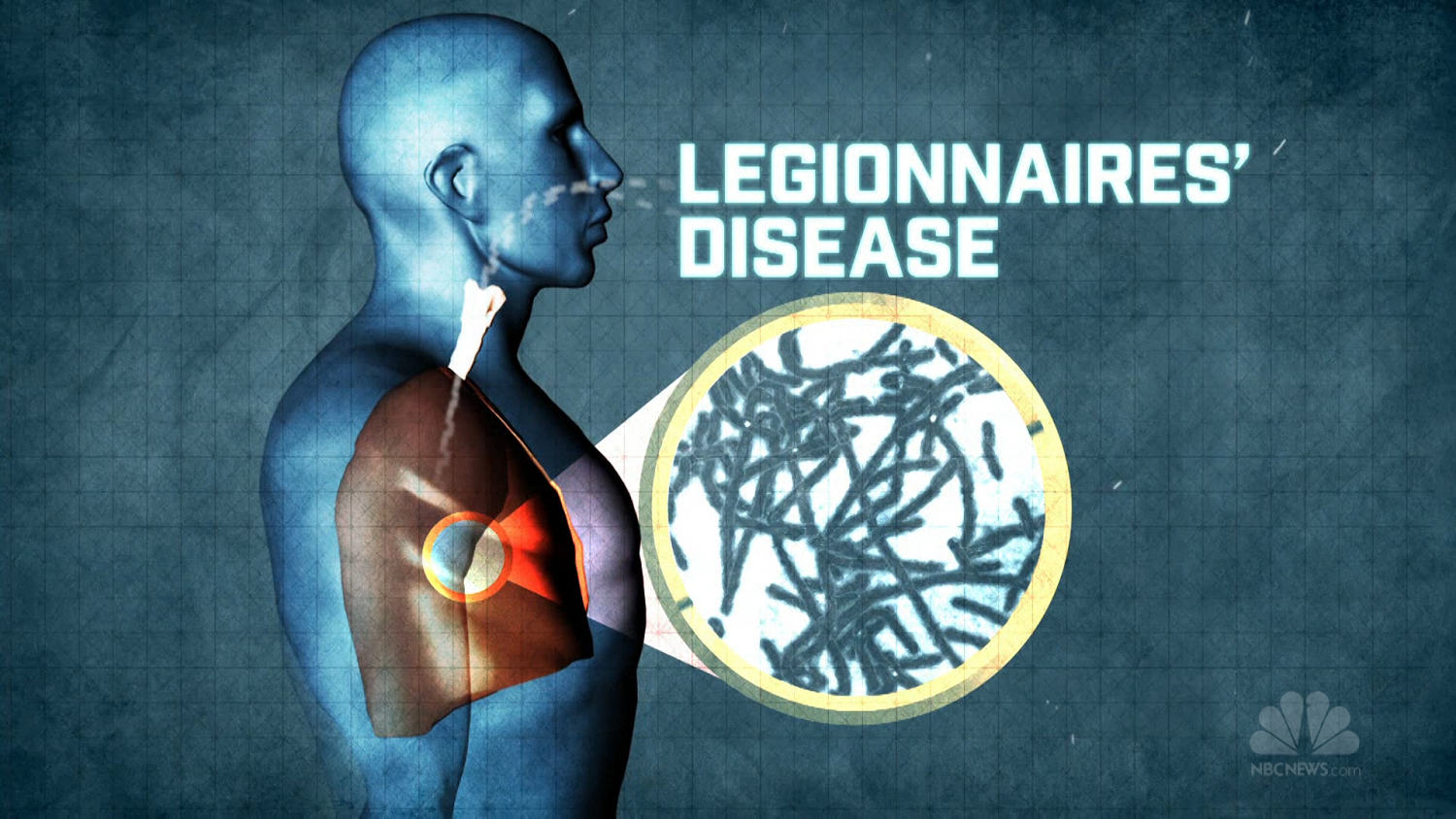 The Brief Deadly History Of Legionnaires Disease [ 844 x 1500 Pixel ]