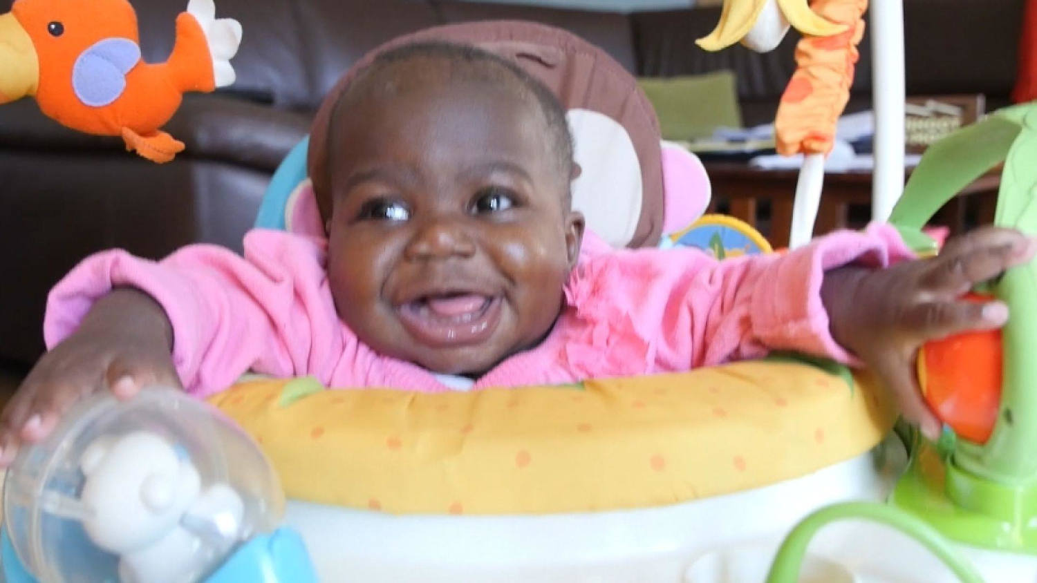 Parasitic Twin Removed From Baby Girl