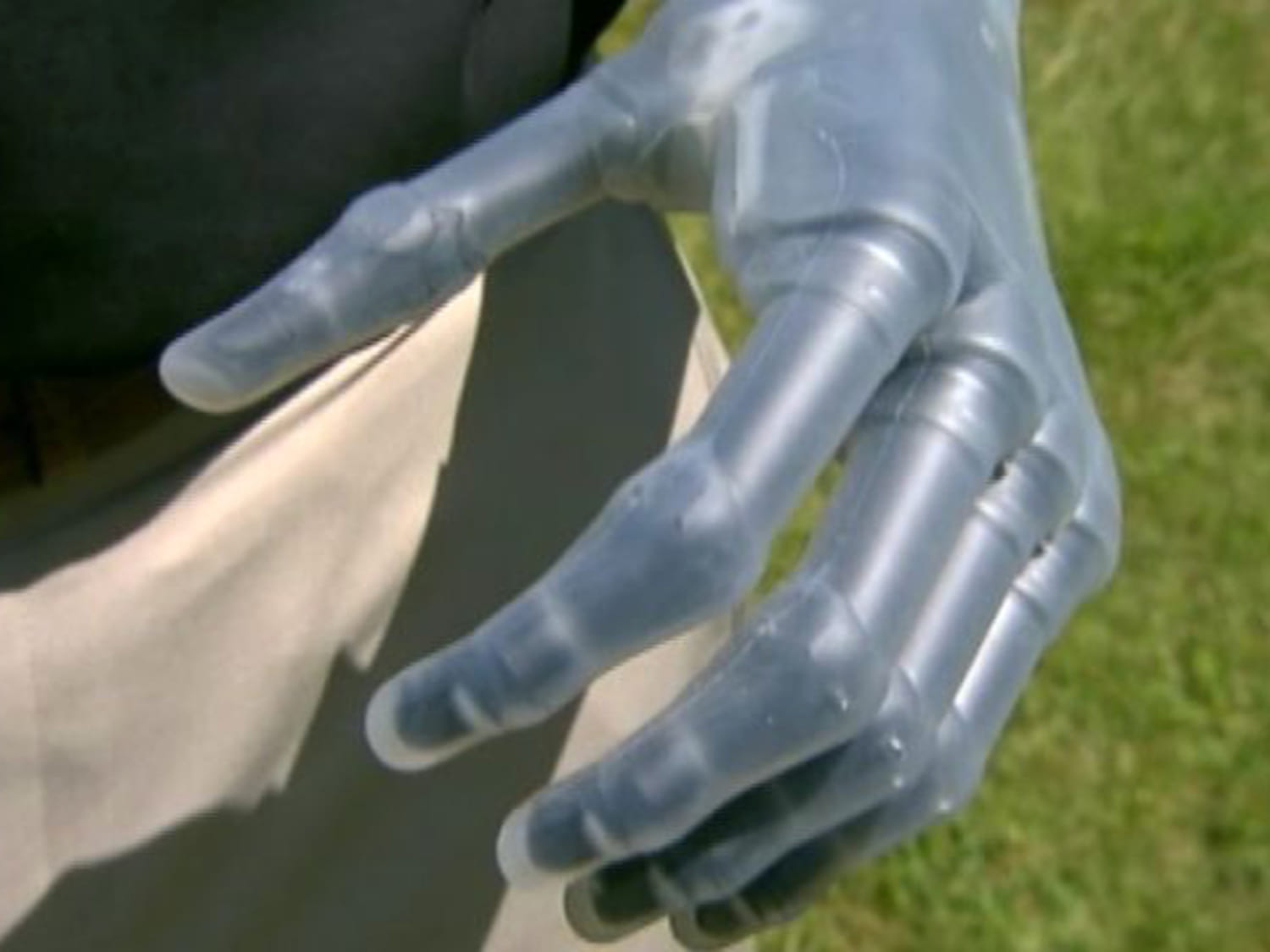 Amputee ditches prosthetic hook for bionic hand