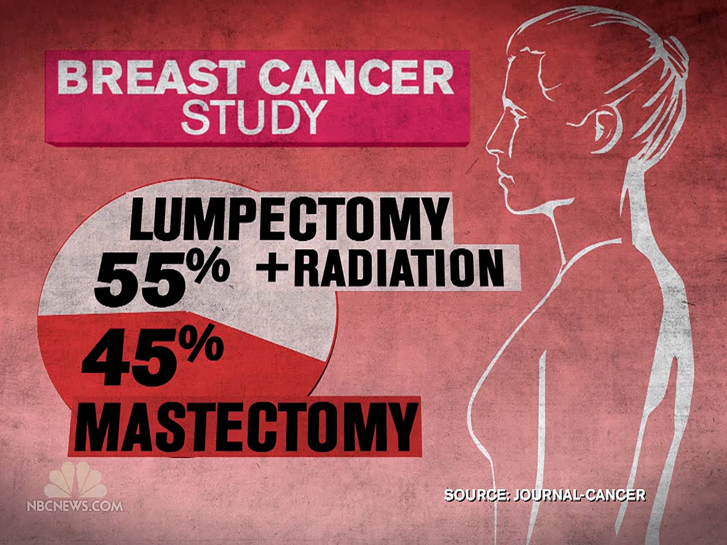 Pin on Mastectomy Resources