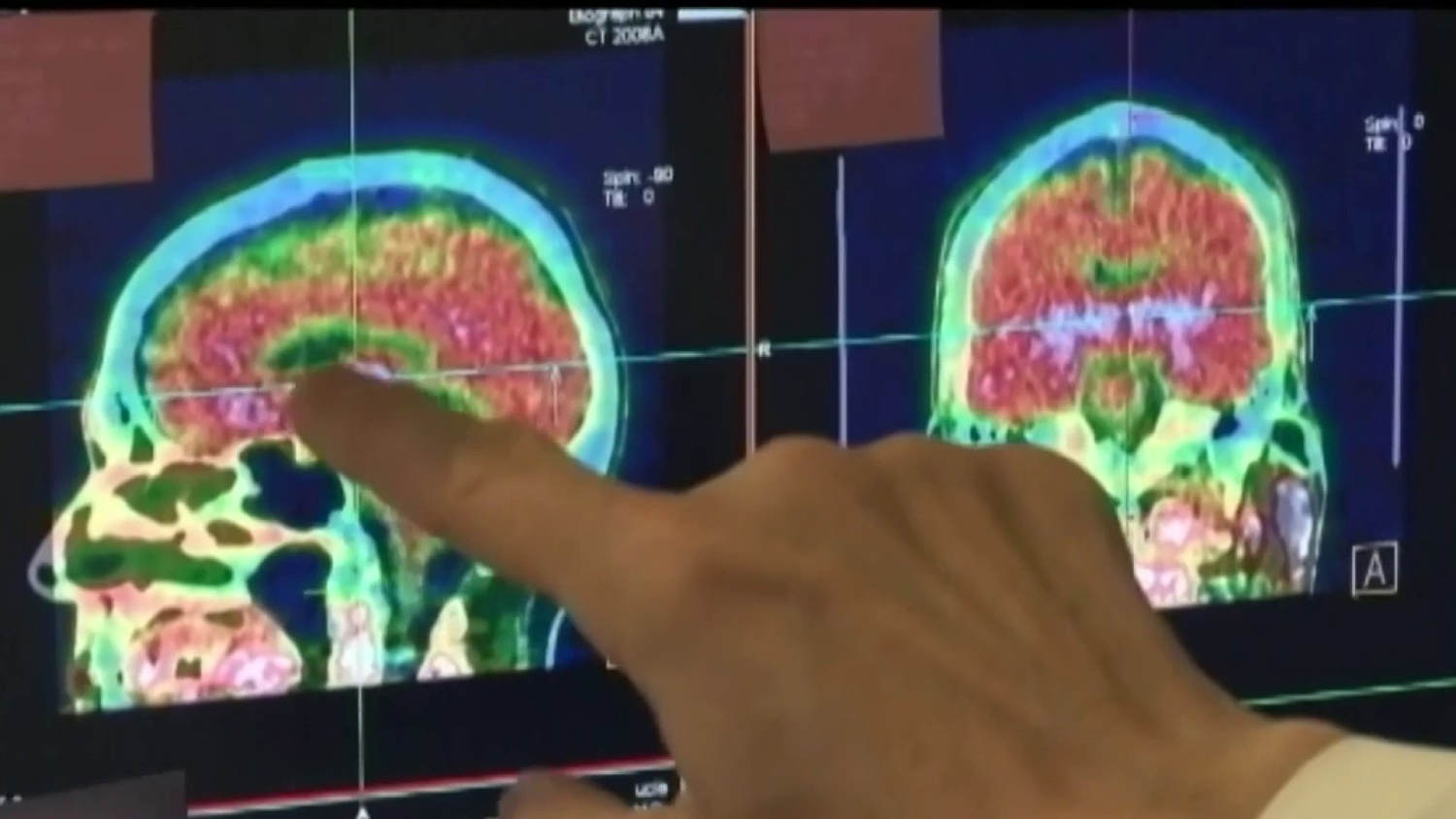 La FDA analiza la aprobación del primer medicamento psicodélico
