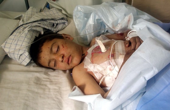 Image: An Afghan boy injured in a blast lies in the hospital