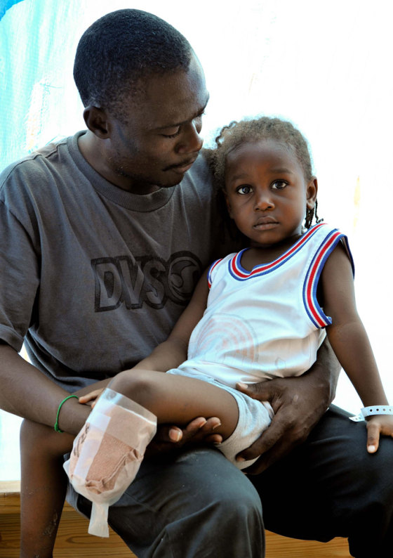 Doctors at Good Samaritan Hospital in Jimani, Dominican Republic, had to amputate 4-year-old Schneily Similien’s lower leg because of injuries suffered in the Haiti earthquake. His father, Ducarmel Similien, says he will do whatever it takes to get a prosthetic leg for his boy.