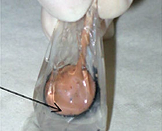 Image: Glucose-based biofuel cell implant