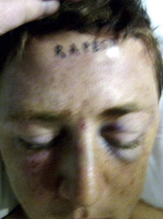 Image: In this photo provided by Lucy Ford, the word \"rapest\" is pictured tattooed on the forehead of her son, Stetson Johnson