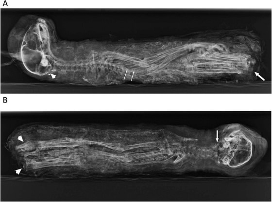 The cat mummy from the side (A) and front (B). In (A), the thin white arrows indicate the squeezed thorax; white arrow, fractured back bones of the tail; white arrowhead, fracture/hole in the occipital region of the skull.