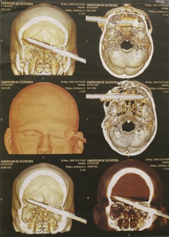 APTOPIX Brazil Spear in Head