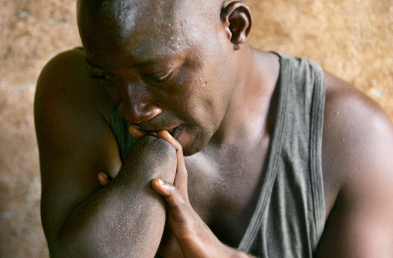 Image: James Pombo, who lost his hand during a civil war in Sierra Leone, is pictured 02 April 2006 at the amputees camp near Freetown, Sierra Leone