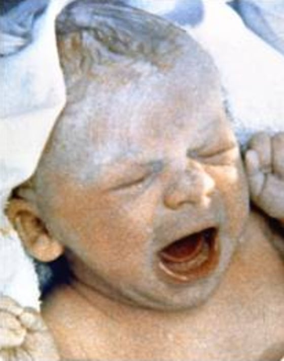 Louise Brown, the world's first "test-tube" baby, is shown shortly after she was born at Oldham General Hospital in England on July 25, 1978.