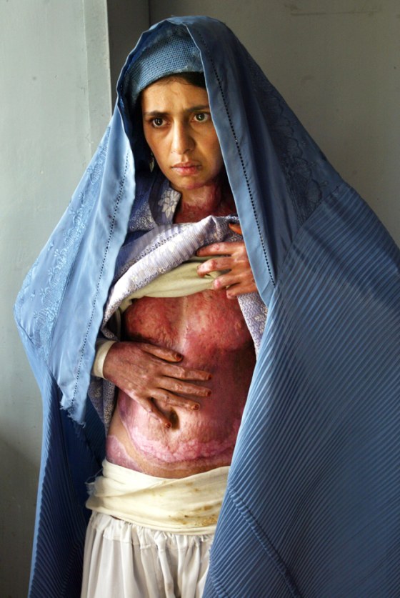 Desperation Drives Women To Self Immolation In Herat