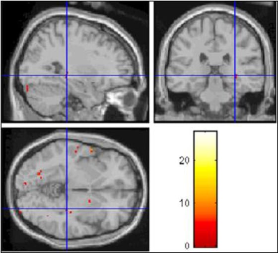 This scan of the brain of a lying study participant shows activity in the hippocampus region.