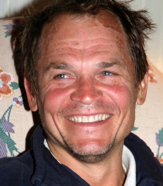 Gilbert Dewey Gaedcke III smiles during an interview on Saturday. His forehead and face are sunburn from his five days lost near the Big Island's Kilauea volcano.