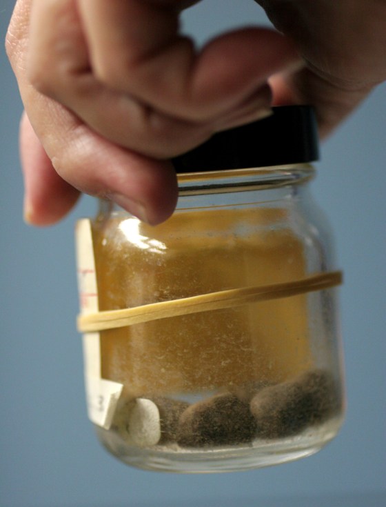 Dwight D. Eisenhower's gallstones, in the original specimen pathology jar, is in the collection at the National Museum of Health and Medicine in Washington.