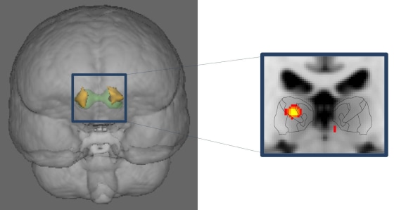 Image: Migraine brain