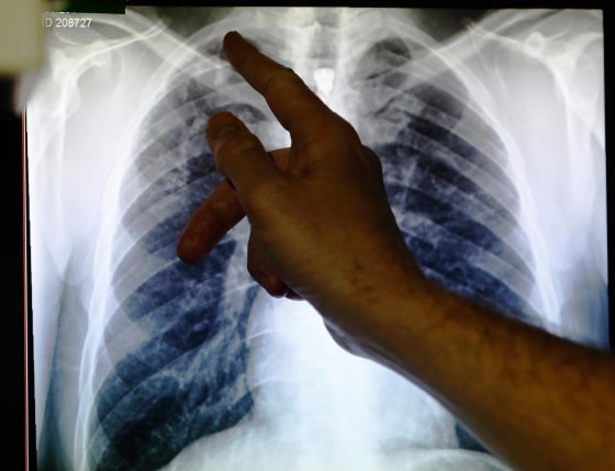 An X-ray showing a pair of lungs infected with TB (tuberculosis)