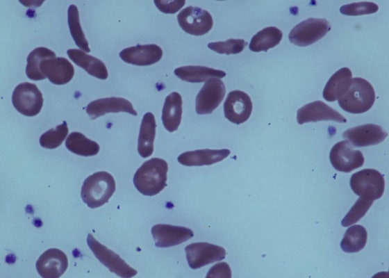 Image: Red blood cells in a patient with sickle cell disease