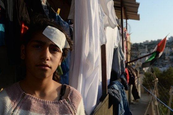 Fatimah Kayed Al-Rajabi, 13 years old, daughter of Abeer Al-Rajabi, was shot by rubber bullet in the head 3 days ago while sitting on the balcony in her house in Silwan.