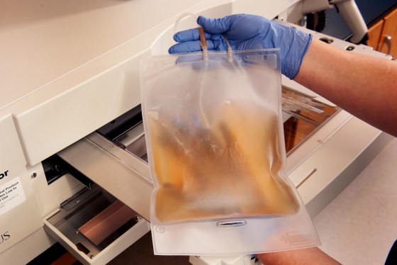 Blood plasma at Emory University. A different team found infusing plasma into Alzheimer's patients is safe and it showed hints of helping their symptoms in some ways. 