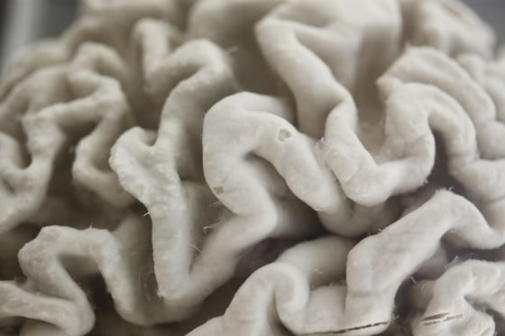 Image: Alzheimer's disease