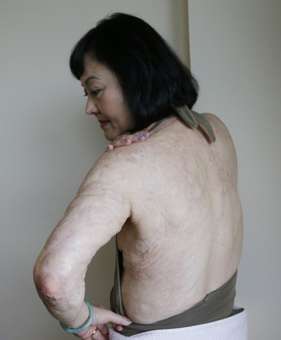 Napalm girl from Vietnam War undergoes laser treatment in US to remove scars pic