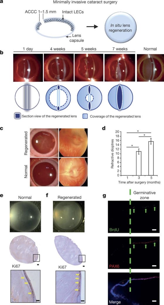 Kang Zhang of Sun Yat-sen University of China and the University of California, San Diego and colleagues developed a new technique for tricking the eye into regenerating a lens.