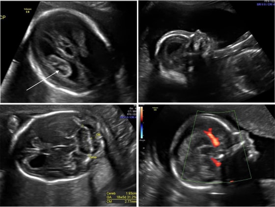 Images of normal versus Zika-affected MRIs. A. Enlarged, hydropic choroid plexus (arrow). B. Normal profile without sloping forehead. C. Normal D. Color Doppler showing incomplete formation of the brain structure called the corpus callosum.