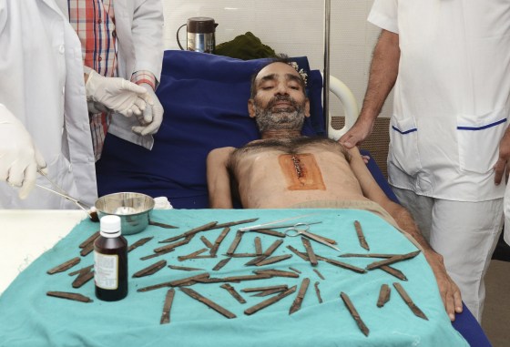Image: Surgeons removed 28 knives, but further investigation revealed there were a dozen more.