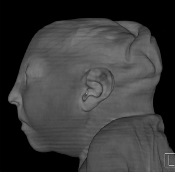 CT image 1 week after delivery at 38 weeks of gestational age in the case of a 24-year-old woman pregnant with twins, with characteristic rash at 9 weeks of pregnancy and confirmed Zika virus infection.