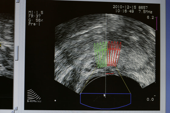 Cancer Of Prostate Ultrasound