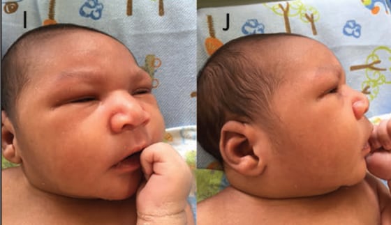 Assessment of a Series of 13 Infants with Congenital Zika Virus Infection without Microcephaly at Birth