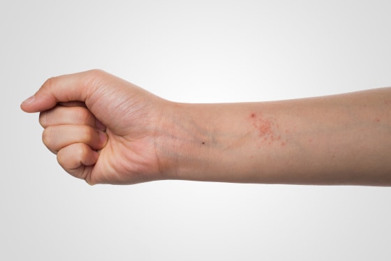 eczema skin on hand