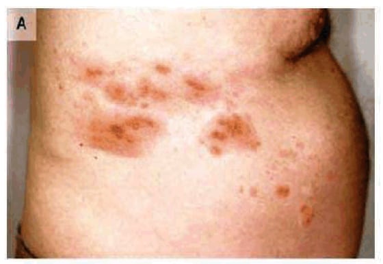 Image: Herpes Zoster, which is often called shingles