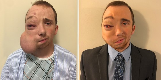 Idaho man with face tumor reveals surgery results